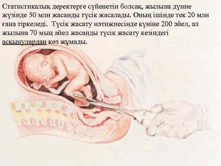 Статистикалық деректерге сүйенетін болсақ, жылына дүние жүзінде 50 млн жасанды түсік жасалады. Оның ішінде