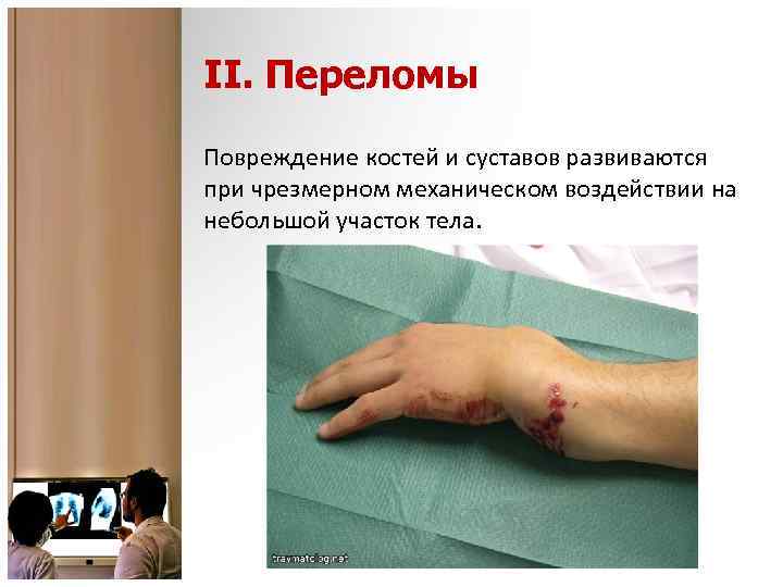 II. Переломы Повреждение костей и суставов развиваются при чрезмерном механическом воздействии на небольшой участок