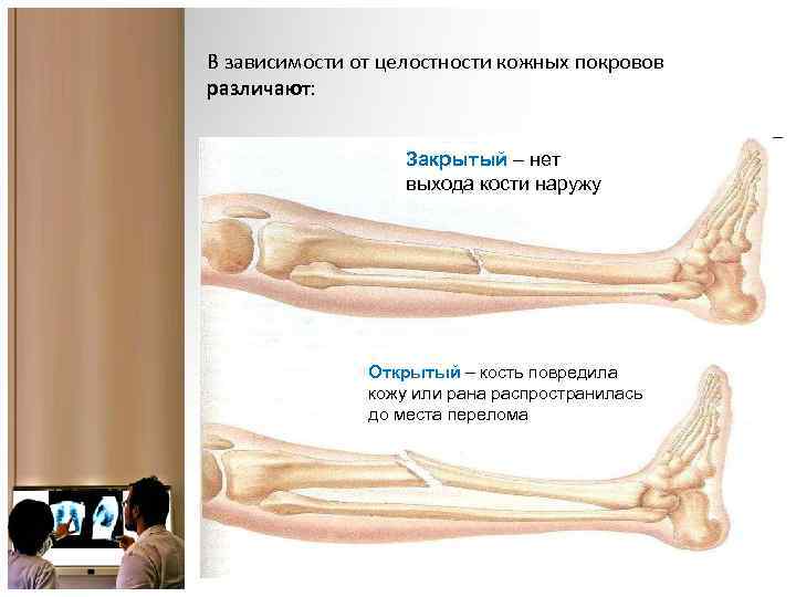  В зависимости от целостности кожных покровов различают: Закрытый – нет выхода кости наружу
