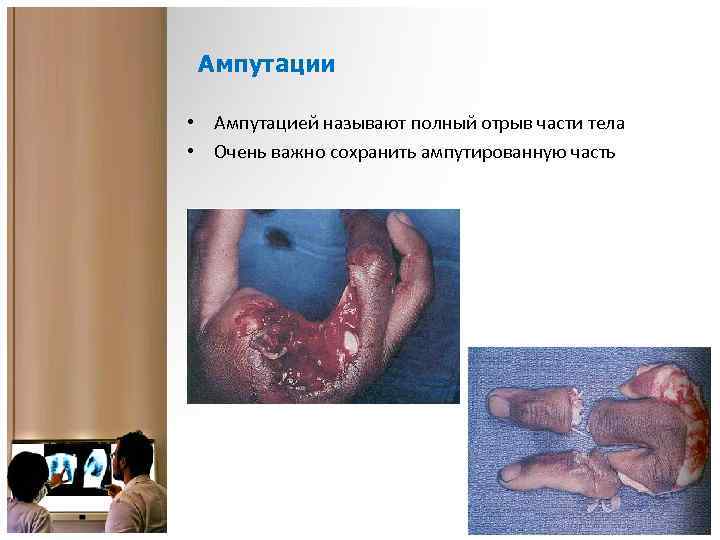 Ампутации • Ампутацией называют полный отрыв части тела • Очень важно сохранить ампутированную часть