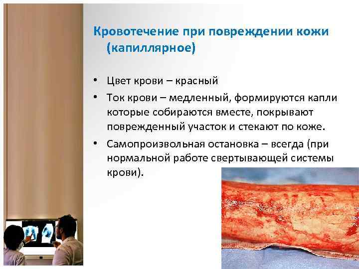 Кровотечение при повреждении кожи (капиллярное) • Цвет крови – красный • Ток крови –