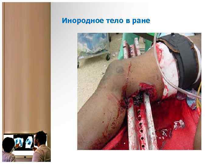 Инородное тело в ране 