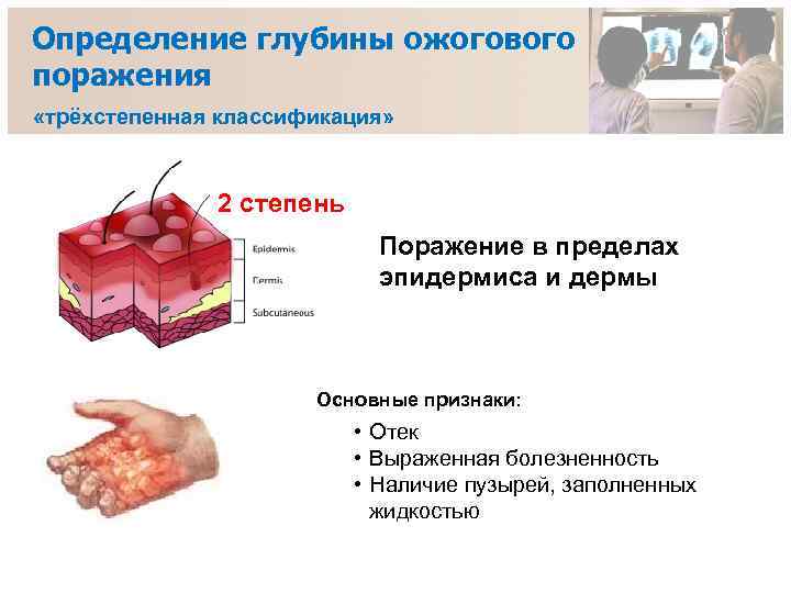 Определение глубины ожогового поражения «трёхстепенная классификация» 2 степень Поражение в пределах эпидермиса и дермы