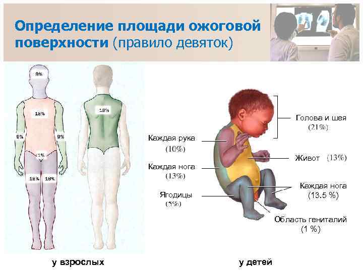 Определение площади ожоговой поверхности (правило девяток) Голова и шея Каждая рука Живот Каждая нога