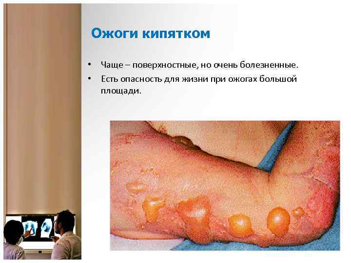 Ожоги кипятком • Чаще – поверхностные, но очень болезненные. • Есть опасность для жизни
