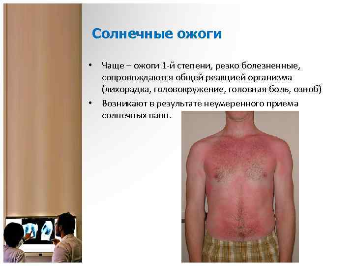 Солнечные ожоги • Чаще – ожоги 1 -й степени, резко болезненные, сопровождаются общей реакцией