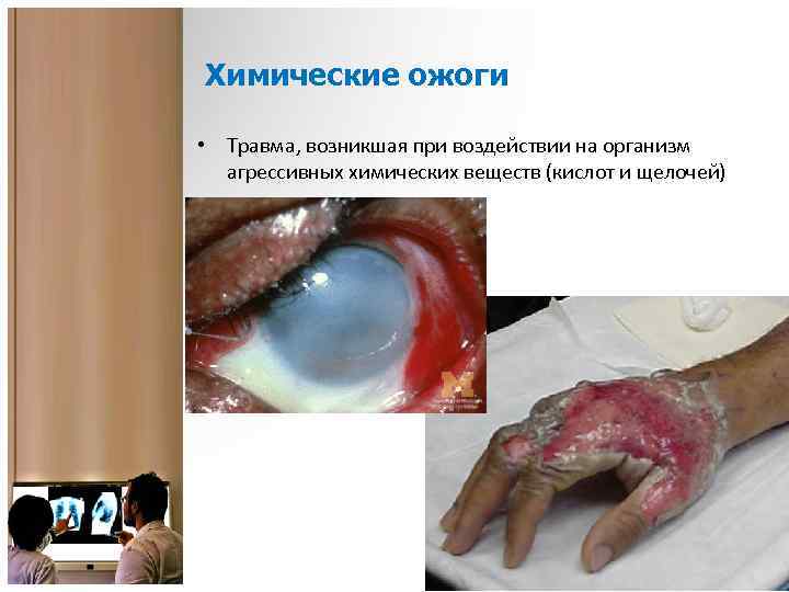 Химические ожоги • Травма, возникшая при воздействии на организм агрессивных химических веществ (кислот и