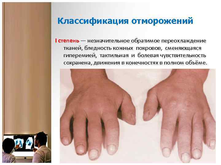 Классификация отморожений I степень — незначительное обратимое переохлаждение тканей, бледность кожных покровов, сменяющаяся гиперемией,