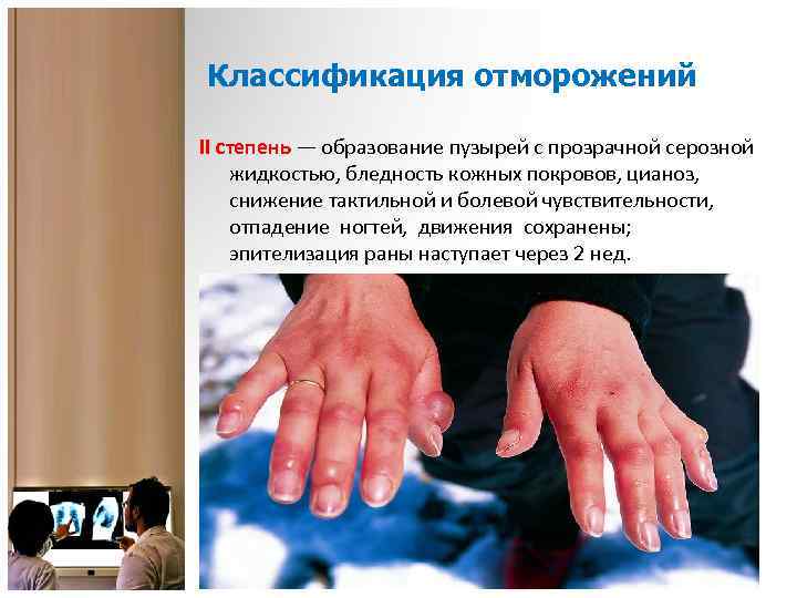 Классификация отморожений II степень — образование пузырей с прозрачной серозной жидкостью, бледность кожных покровов,