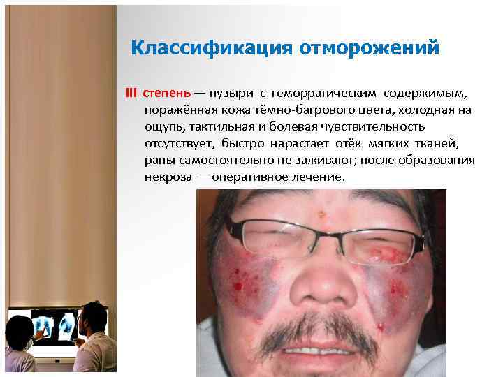 Классификация отморожений III степень — пузыри с геморрагическим содержимым, поражённая кожа тёмно-багрового цвета, холодная