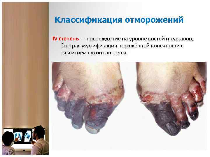 Классификация отморожений IV степень — повреждение на уровне костей и суставов, быстрая мумификация поражённой