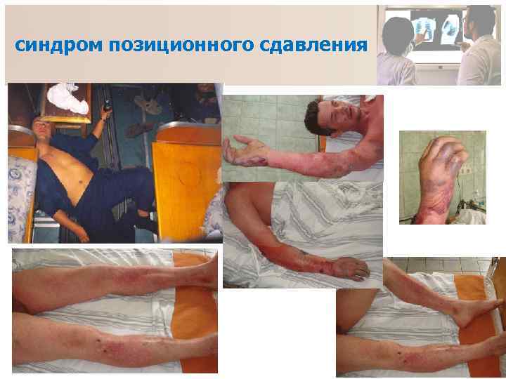 синдром позиционного сдавления 