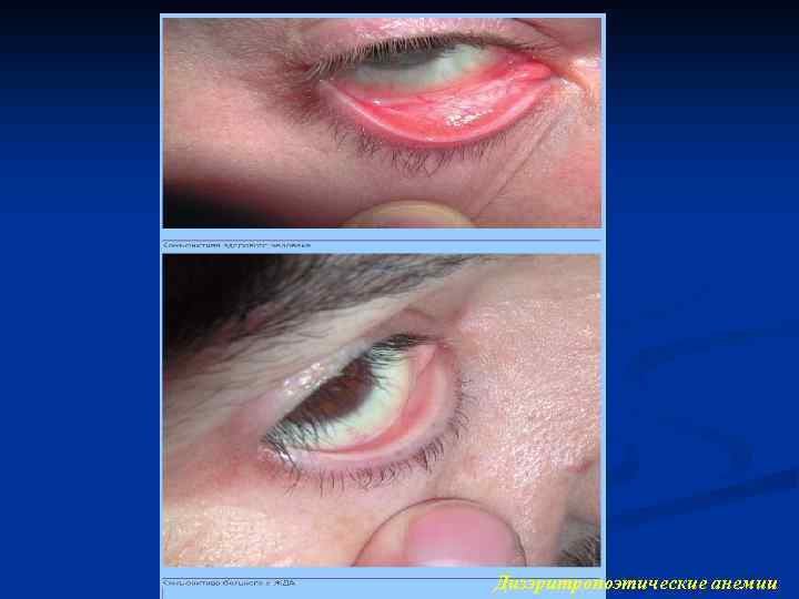 Дизэритропоэтические анемии 