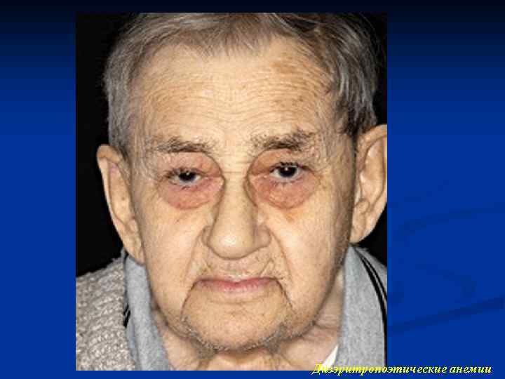 Дизэритропоэтические анемии 