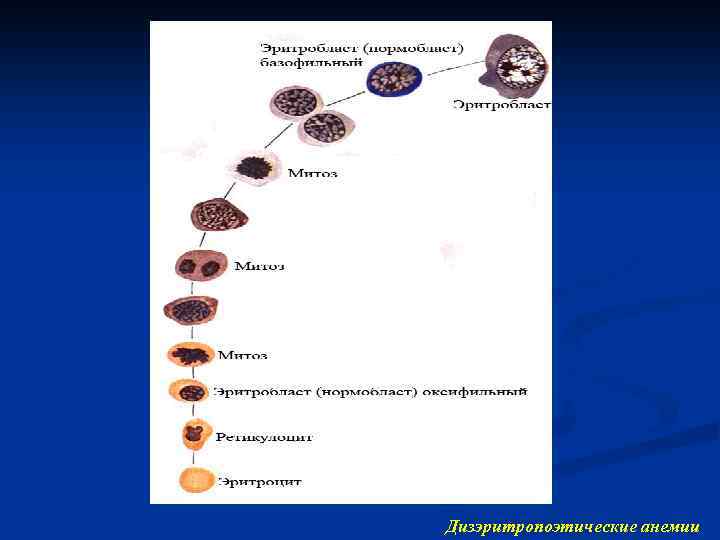 Дизэритропоэтические анемии 