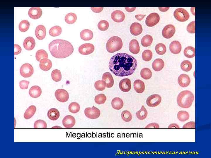 Дизэритропоэтические анемии 