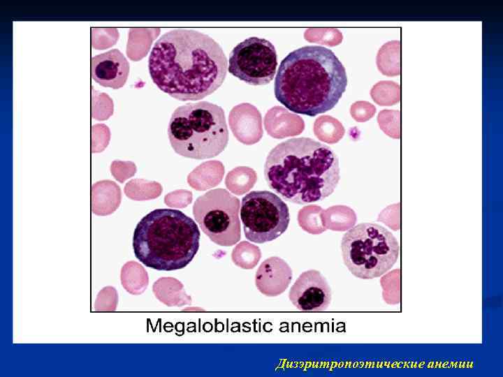 Дизэритропоэтические анемии 