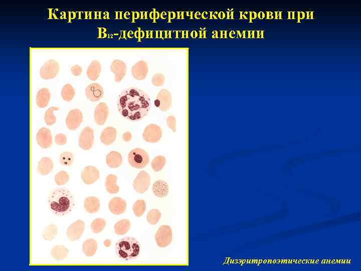 Картина периферической крови при В -дефицитной анемии 12 Дизэритропоэтические анемии 