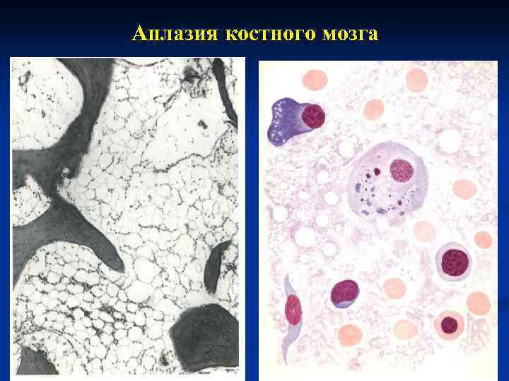 Аплазия костного мозга 