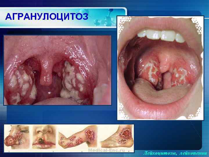 АГРАНУЛОЦИТОЗ Лейкоцитозы, лейкопении 