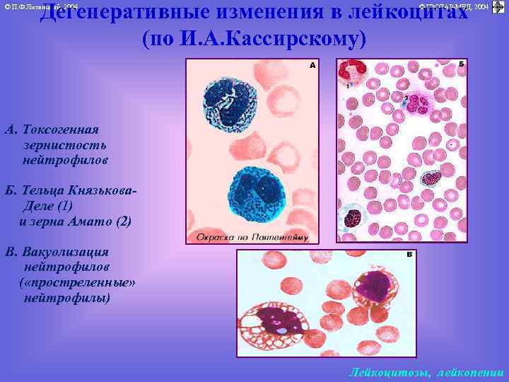 Дегенеративные изменения в лейкоцитах (по И. А. Кассирскому) © П. Ф. Литвицкий, 2004 ©