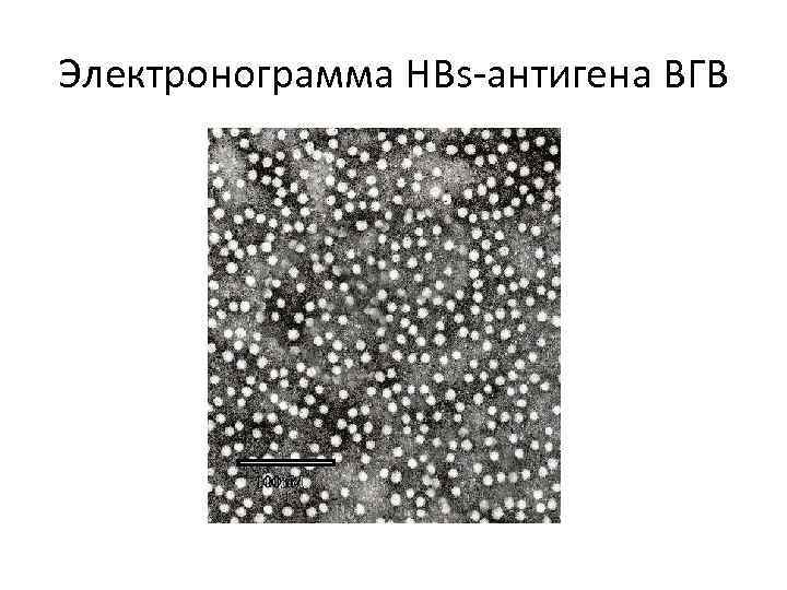 Электронограмма HBs-антигена ВГВ 