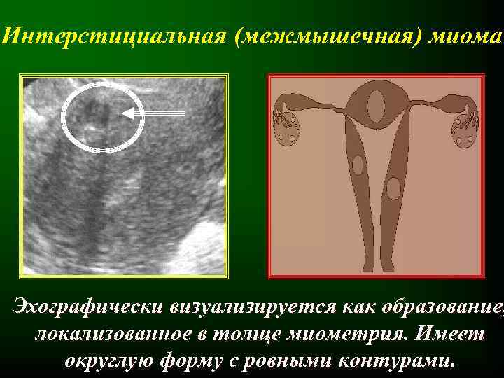 Актуальность лечения миомы матки thumbnail