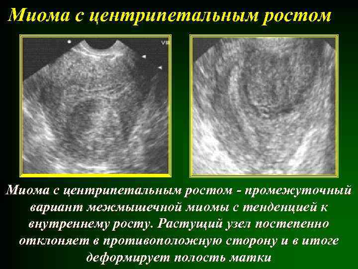 Миома с центрипетальным ростом - промежуточный вариант межмышечной миомы с тенденцией к внутреннему росту.