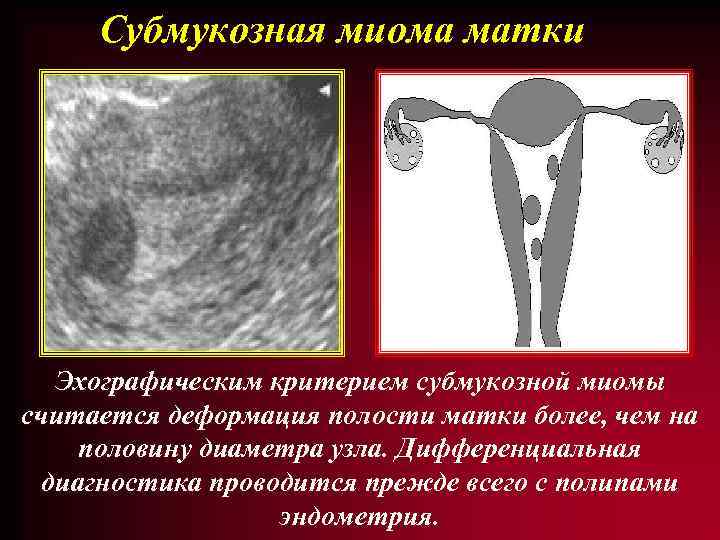 Субмукозная миома матки Эхографическим критерием субмукозной миомы считается деформация полости матки более, чем на