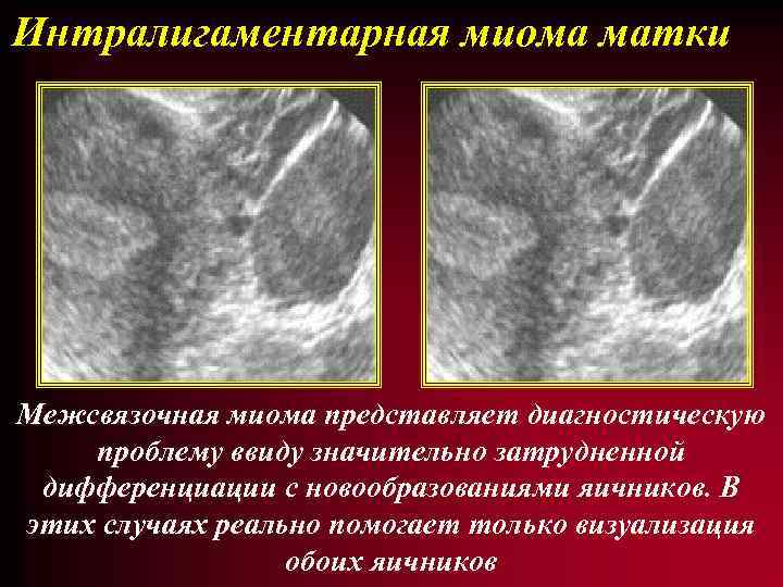 Интралигаментарная миома матки Межсвязочная миома представляет диагностическую проблему ввиду значительно затрудненной дифференциации с новообразованиями