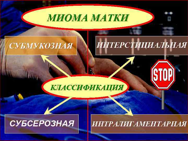 МИОМА МАТКИ СУБМУКОЗНАЯ ИНТЕРСТИЦИАЛЬНАЯ КЛАССИФИКАЦИЯ СУБСЕРОЗНАЯ ИНТРАЛИГАМЕНТАРНАЯ 