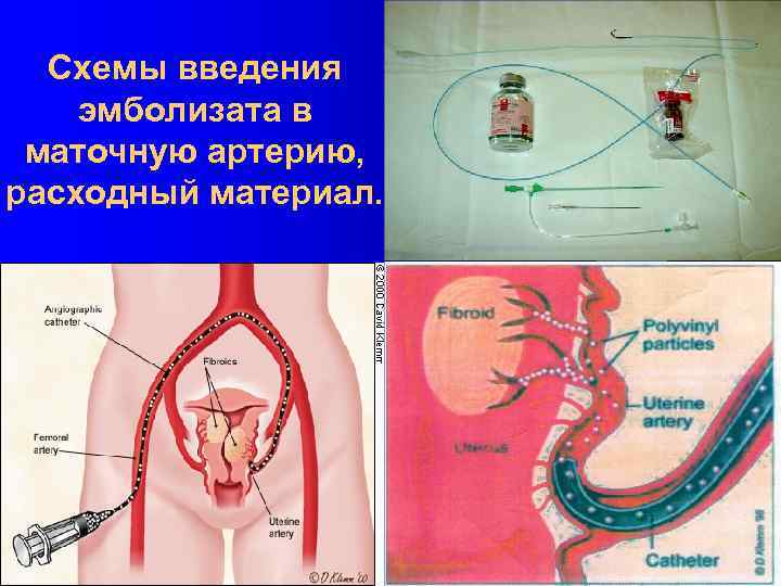 Эмболизация маточных артерий при миоме