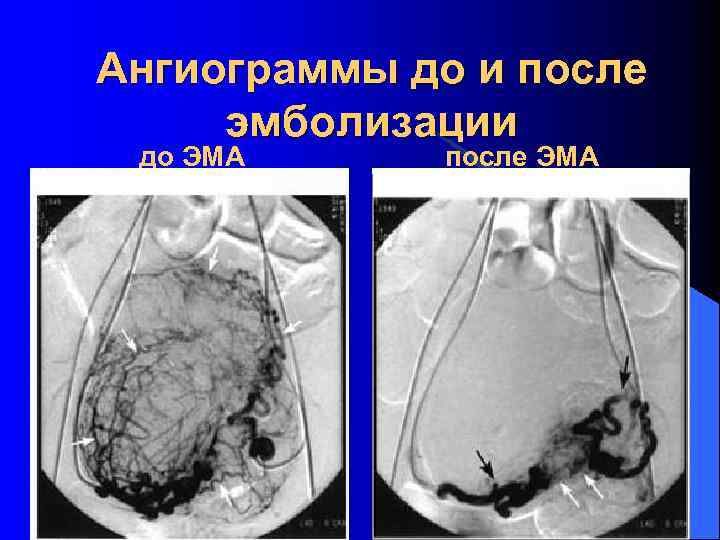 Ангиограммы до и после эмболизации до ЭМА после ЭМА 