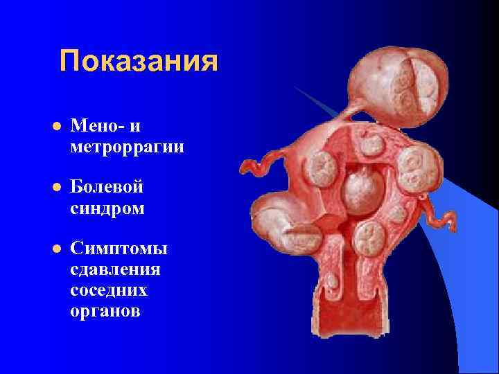 Показания l Мено- и метроррагии l Болевой синдром l Симптомы сдавления соседних органов 