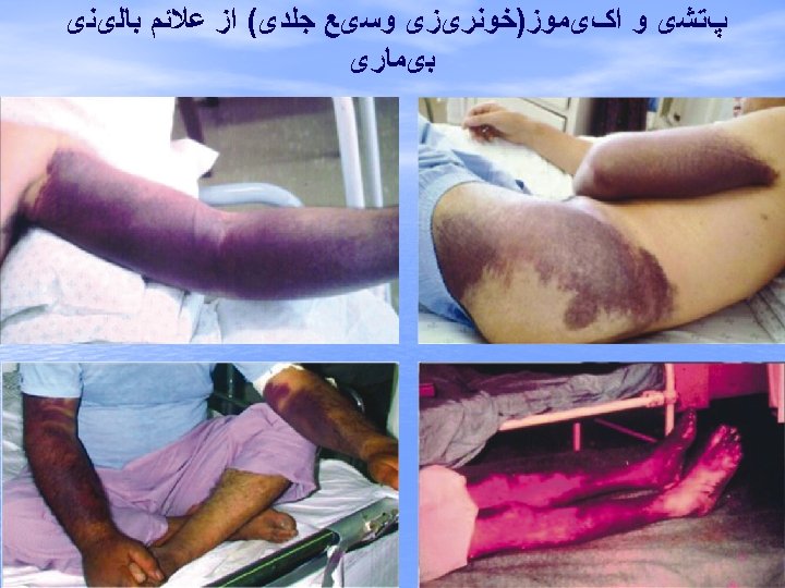  پﺘﺸی ﻭ ﺍکیﻤﻮﺯ)ﺧﻮﻧﺮیﺰی ﻭﺳیﻊ ﺟﻠﺪی( ﺍﺯ ﻋﻼﺋﻢ ﺑﺎﻟیﻨی ﺑیﻤﺎﺭی 