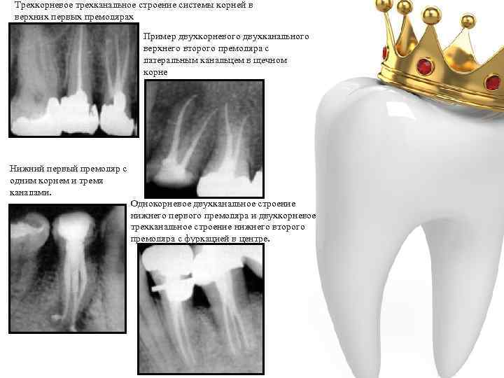 Трехкорневое трехканальное строение системы корней в верхних первых премолярах Пример двухкорневого двухканального верхнего второго