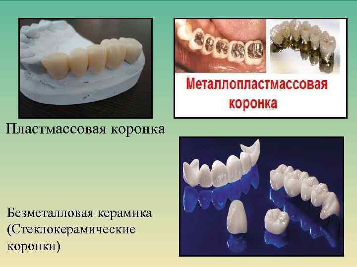 Пластмассовая коронка Безметалловая керамика (Стеклокерамические коронки) 