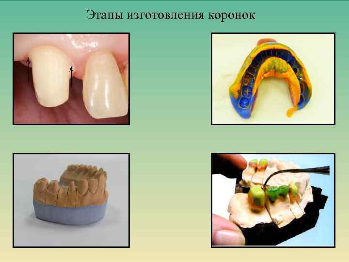 Этапы изготовления коронок 