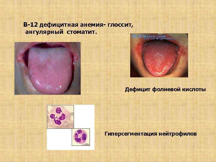 В-12 дефицитная анемия- глоссит, ангулярный стоматит. Дефицит фолиевой кислоты Гиперсегментация нейтрофилов 
