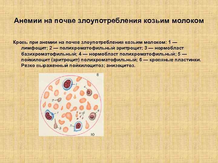 Анемии на почве злоупотребления козьим молоком Кровь при анемии на почве злоупотребления козьим молоком: