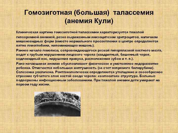 Гомозиготная (большая) талассемия (анемия Кули) Клиническая картина гомозиготной талассемии характеризуется тяжелой гипохромной анемией, резко