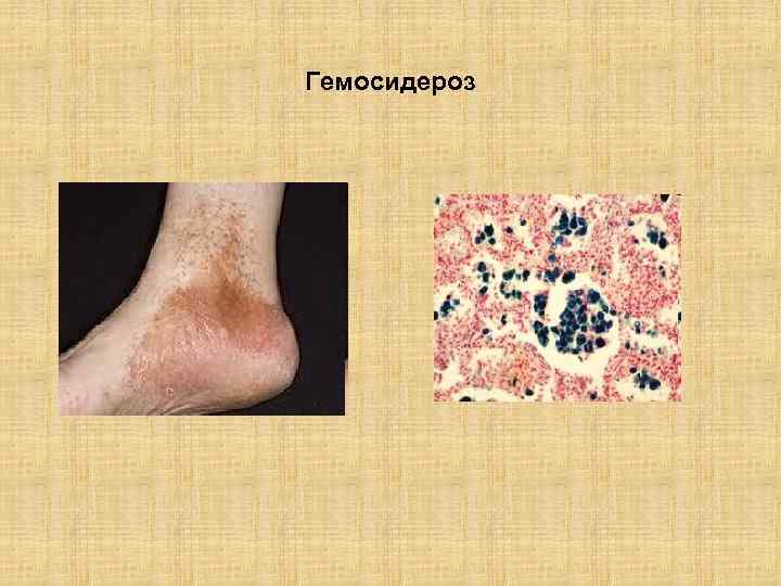 Гемосидероз 