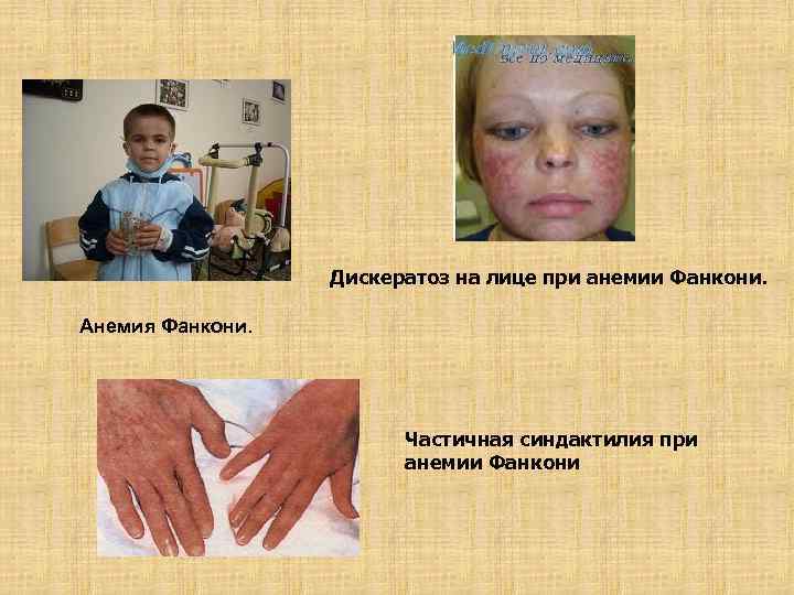 Дискератоз на лице при анемии Фанкони. Анемия Фанкони. Частичная синдактилия при анемии Фанкони 