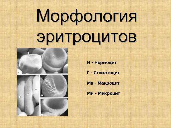 Морфология эритроцитов Н - Нормоцит Г - Стоматоцит Ма - Макроцит Ми - Микроцит