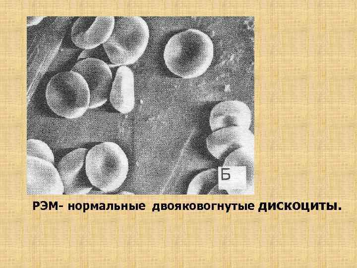 РЭМ- нормальные двояковогнутые дискоциты. 