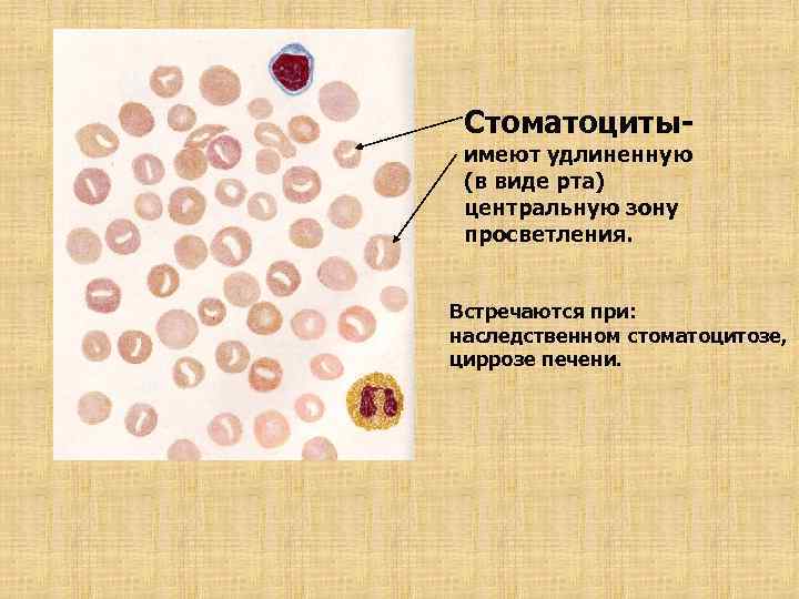 Стоматоцитыимеют удлиненную (в виде рта) центральную зону просветления. Встречаются при: наследственном стоматоцитозе, циррозе печени.