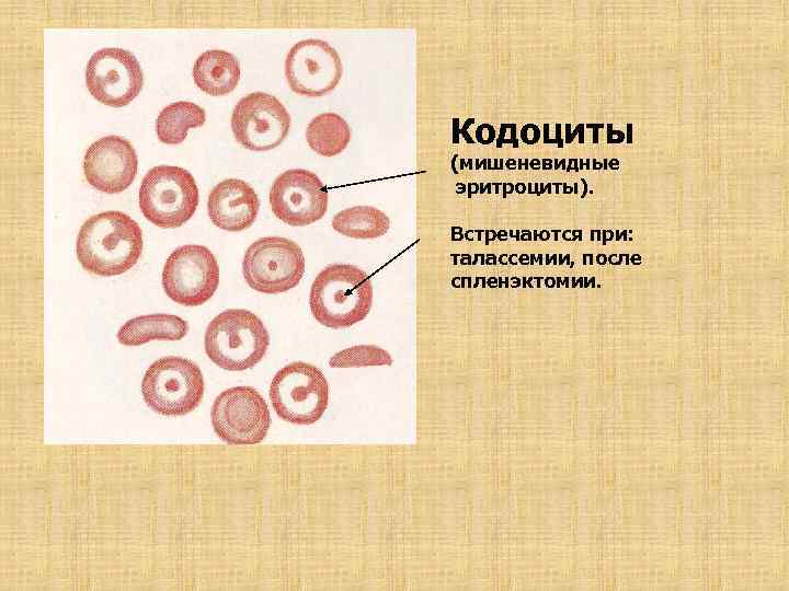 Кодоциты (мишеневидные эритроциты). Встречаются при: талассемии, после спленэктомии. 