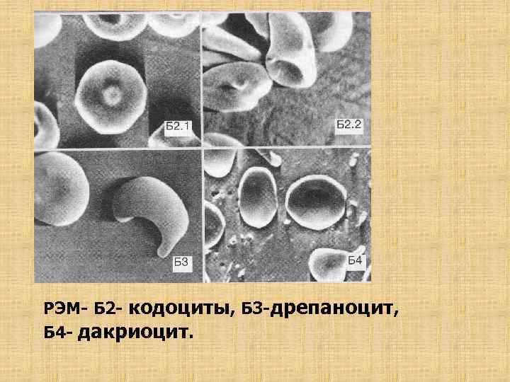 РЭМ- Б 2 - кодоциты, Б 3 -дрепаноцит, Б 4 - дакриоцит. 