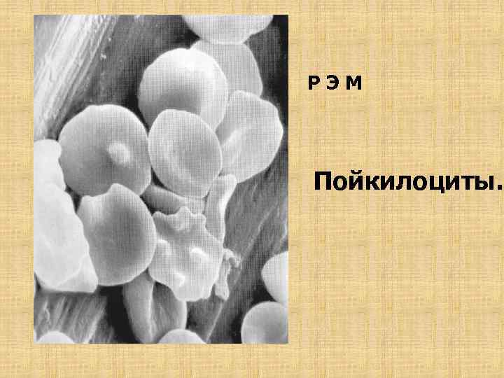 РЭМ Пойкилоциты. 