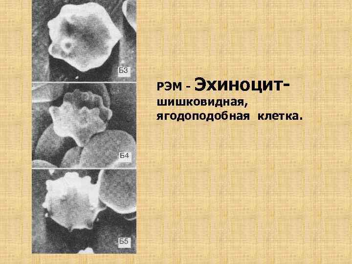 РЭМ - Эхиноцитшишковидная, ягодоподобная клетка. 